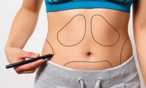 8 Coisas Importantes que Você Precisa Saber Antes de Fazer uma Lipoaspiração