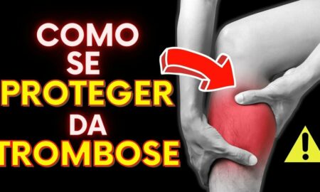 Como Prevenir a Trombose nas Pernas | 7 Alimentos que Melhoram a Circulação Sanguínea