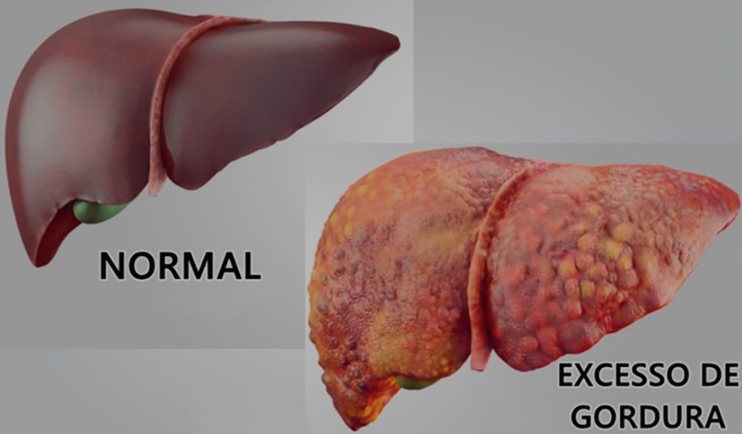 Gordura no Fígado: Esses Alimentos São uma Bomba